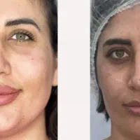 مدل فیلر صورت در کلینیک نوا|خدمات آرایشگری و زیبایی|شیراز, ستارخان|دیوار