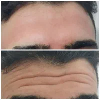 خدمات ژل و بوتاکس .مزووآنزیم و..خانم ها وآقایان)