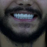 کامپوزیت لمینیت ایمپلنت اقساط ویژه
