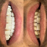 دندانپزشکی اقساطی،جشنواره کامپوزیت و لمینیت|خدمات آرایشگری و زیبایی|مشهد, سید رضی|دیوار