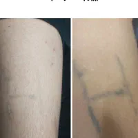 پاک کردن تاتو با دستگاه لیزر پیشرفته