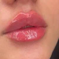 تخفیف 40درصد ژل بوتاکس فیلر فقط دوشنبه