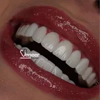 دندانیزشکی کامپوریت لمینت اینیلنت|خدمات آرایشگری و زیبایی|تهران, قیطریه|دیوار