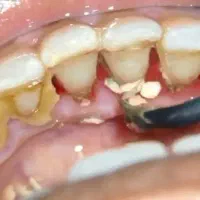 جرم گیری دندان با تعرفه دولتی تحت پوشش بیمه|آرایشی، بهداشتی، درمانی|اصفهان, دهنو|دیوار