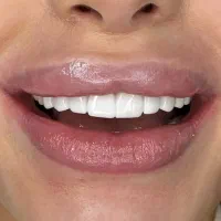 مگه میشه کامپوزیت دندان با این قیمت +هدیه|خدمات آرایشگری و زیبایی|کرج, فاز ۳ گوهردشت|دیوار