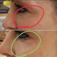 برای همیشه از شر چین و چروک پوستت خلاص شو