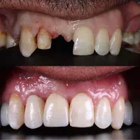 اوردنچر جایگزین دندان مصنوعی قدیمی