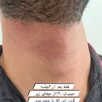 تزریق ژل بوتاکس لیزر فیلر فیشال پاک کردن تاتو|خدمات آرایشگری و زیبایی|قدس, شهر‌قدس|دیوار