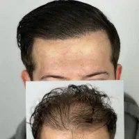 دیگه با ریزش موهات خداحافظی کن|آرایشی، بهداشتی، درمانی|کرج, عظیمیه|دیوار