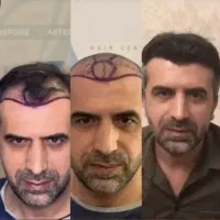 کاشت مو ابرو بلفاروپلاستی مزو تراپی پی آرپی|خدمات آرایشگری و زیبایی|تهران, صادقیه|دیوار