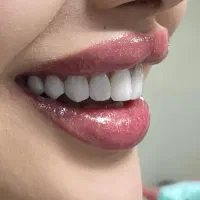 کامپوزیت و لمینت دندان|خدمات آرایشگری و زیبایی|ساری, |دیوار