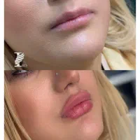 تزریق ژل و بوتاکس (اف ویژه ب مناسبت عید مبعث )|خدمات آرایشگری و زیبایی|مشهد, وکیل‌آباد|دیوار