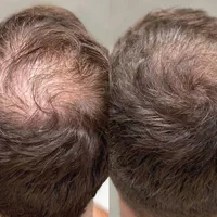 پی آر پی مو و صورت prp / مزوتراپی