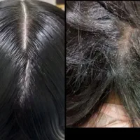 محلول پاکسازی شپش ورشک تضمینی