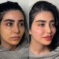 ژل لب/گونه/بوتاکس/فیلربینی/مزوپی ار پی