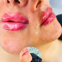 ژل،بوتاکس،پی آرپی،میکرونیدلینگ|خدمات آرایشگری و زیبایی|اصفهان, خانه اصفهان|دیوار