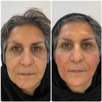 فیلر ‌بوتاکس ژل لب روسی کانتورینگ|خدمات آرایشگری و زیبایی|تهران, جمهوری|دیوار