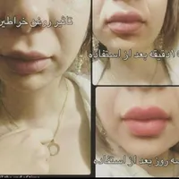 ژل حجم دهنده و لیفت