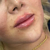 تزریق ژل لب،بوتاکس،زاویه سازی|خدمات زیبایی و سلامت|کرج, جهانشهر|دیوار