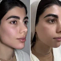 جشنواره تخفیف ژل و بوتاکس