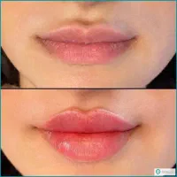 تزریق آموزش ژل بوتاکس چربی|خدمات آرایشگری و زیبایی|صدرا-فارس, فاز ۱|دیوار