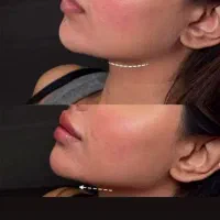 فیلر لب،چونه،گونه،فول فیس،باسن