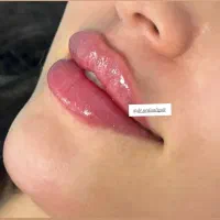جشنواره تزریقات زیبایی توسط پزشک مجرب