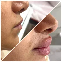 جشنواره بوتاکس مصپورت ۵۹۰ فیلر ۵۹۰ فقط تا آخر آبان