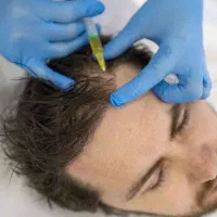 مزونیدلینگ و مزوتراپی مو از 350