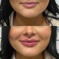 تزریق ژل و بوتاکس نیم فیس و فول فیس
