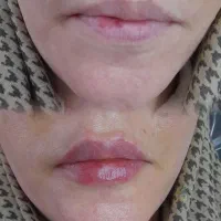 تزریق ژل لب،بوتاکس،مزو تراپی،هایفو تراپی،لیزر|خدمات آرایشگری و زیبایی|فردیس, شهرک ارم|دیوار