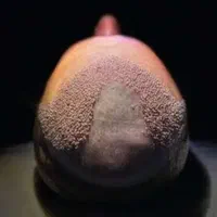کاشت مو کل سر فقط ۱۲  در کلینیک فوق تخصصی