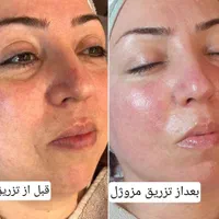 تزریق مزوژل روشن‌کننده جوانساز وبوتاکس|خدمات آرایشگری و زیبایی|آبادان, |دیوار