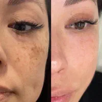 کرم ضدلک بیوممتیک