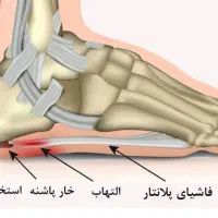 مرکز درمان خارپاشنه و دردپاشنه|خدمات آرایشگری و زیبایی|رزن, |دیوار