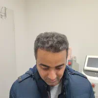 کاشت مو وکاشت ابرو (رایگان)