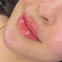 تزریق ژل وبوتاکس فیلر