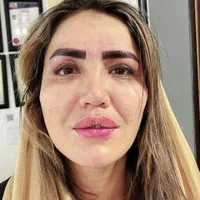 ساکشن وتزریق چربی فیلروبوتاکس وپی ارپی سروصورت ونخ|خدمات آرایشگری و زیبایی|اندیشه, |دیوار