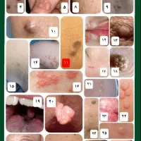 درمان ریشه ای زگیل و تبخال تناسلی