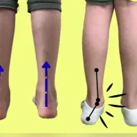 اصلاح زانو پرانتزی و کف پای صاف با حرکات اصلاحی