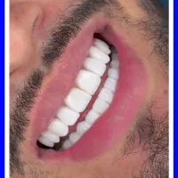کامپوزیت/دندانپزشکی/عصبکشی/لیرینگ/ترمیم پالیش|خدمات زیبایی و سلامت|تهران, تهرانپارس شرقی|دیوار