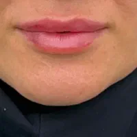 جشنواره بهاره تزریق بوتاکس و فیلر