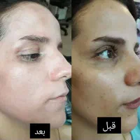 صابون اگزونیک سفید کننده