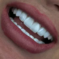 کامپوزیت با ۳۰ درصد تخفیف به همراه وام ۱۰۰ میلیون