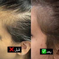 درمان‌های اصولی و قطعی انواع ریزش مو، شوره و پوسته