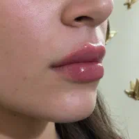 تزریق ژل وبوتاکس
