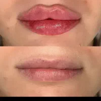 ژل لب گونه چونه زاویه مادلینگ راویه سازی|خدمات آرایشگری و زیبایی|قم, تولید دارو و یخچال|دیوار