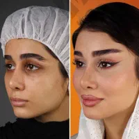 آف RGA لاغری بینی فیلربادی غبغب باسن ژل سینه ابرو