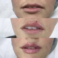 تزریق تخصصی ژل و بوتاکس|خدمات آرایشگری و زیبایی|سبزوار, کوی بهار|دیوار