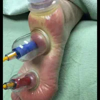 آموزش حجامت وزالو وبادکش